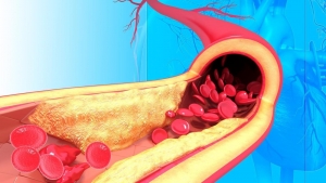 Μια νέα ελληνική υπολογιστική μέθοδος βοηθά να εντοπισθούν έγκαιρα τα προβλήματα στο εσωτερικό των αρτηριών του αίματος